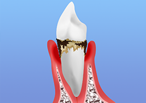 中等度以上の歯周病では麻酔下で歯石取りを行います