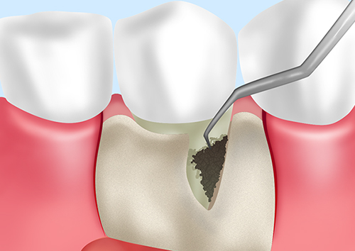 重度の歯周炎の場合は歯周外科処置も行います